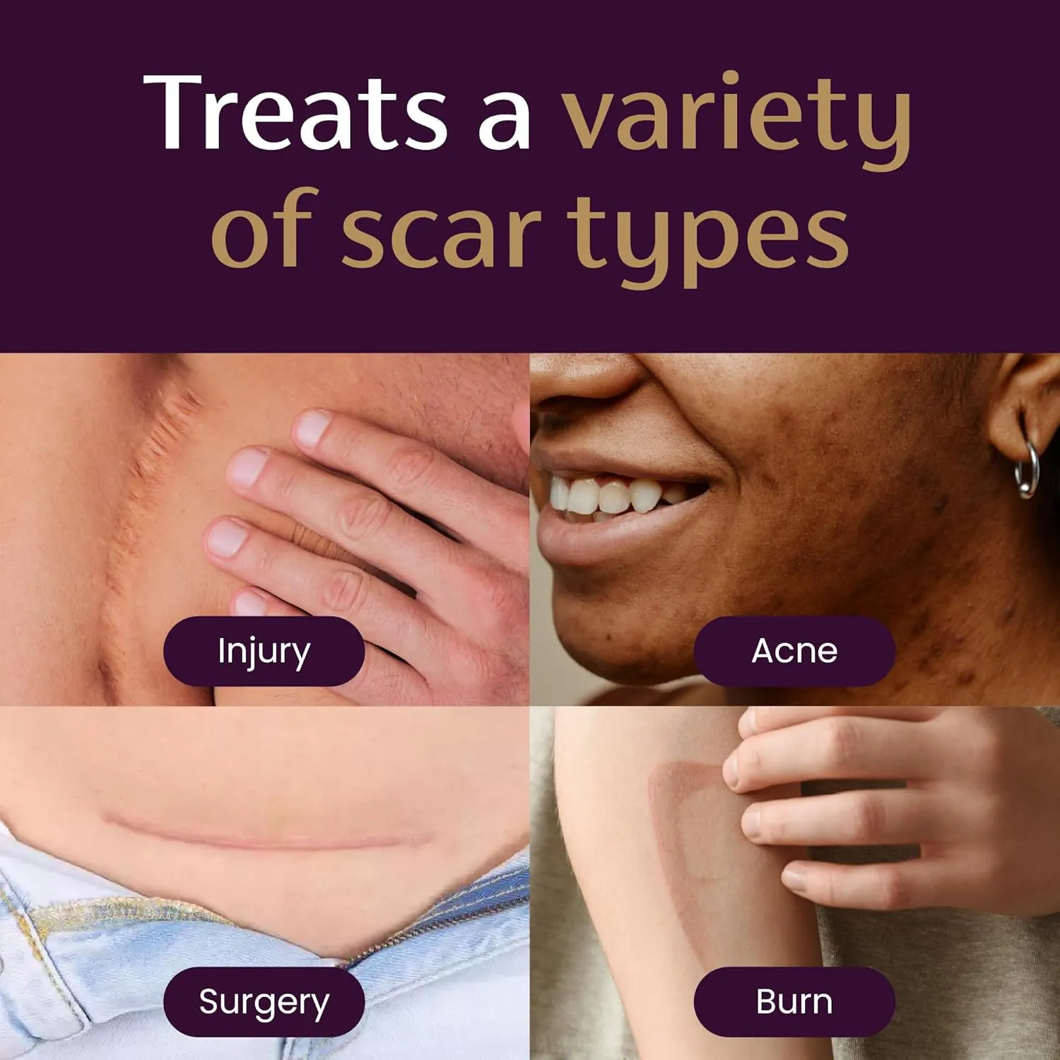 Mederma Scar Cream Plus SPF 30, Sunscreen, Protects from Sun Damage, Reduces the Appearance of Scars, 40 Grams, (2 x 20g)